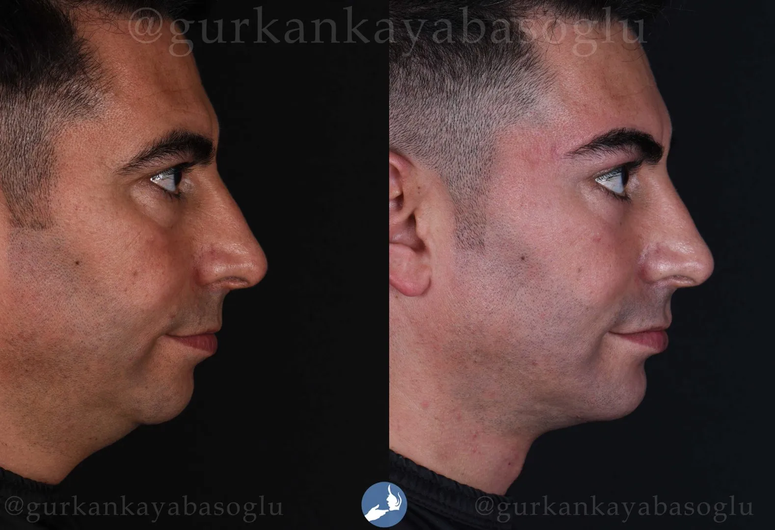 Chin implant (mentoplasty) — before and after, patient of Prof. Dr. Gürkan Kayabaşoğlu