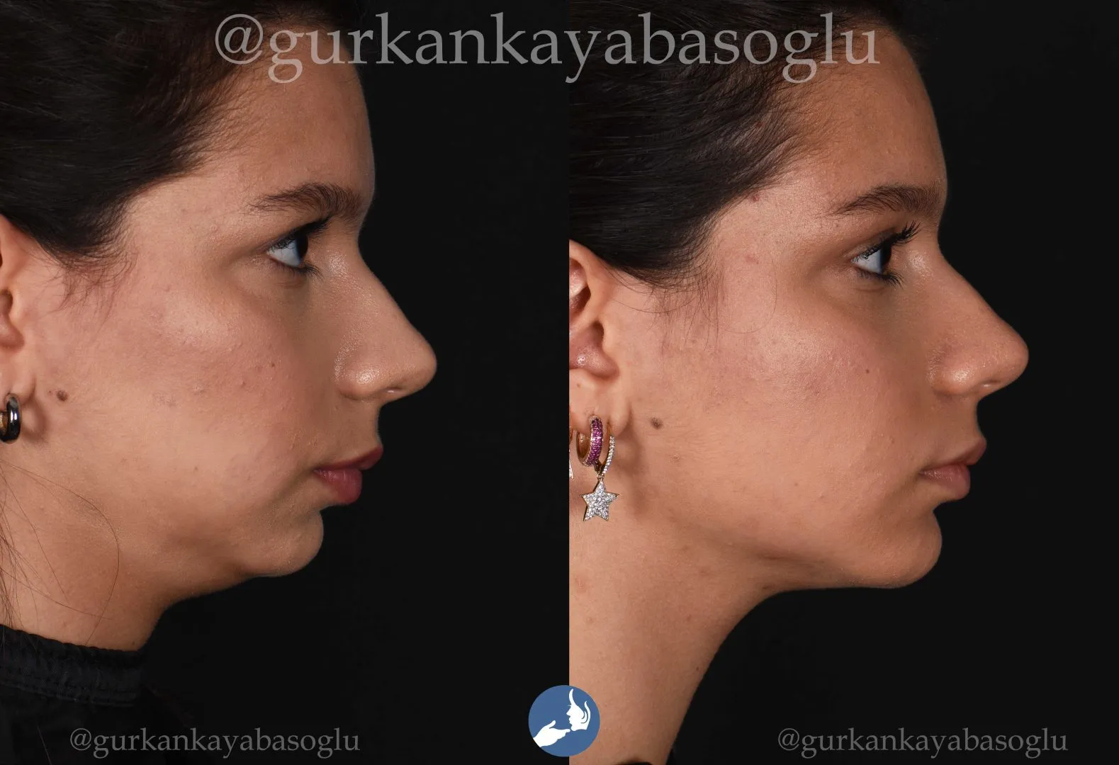 Chin implant (mentoplasty) — before and after, patient of Prof. Dr. Gürkan Kayabaşoğlu