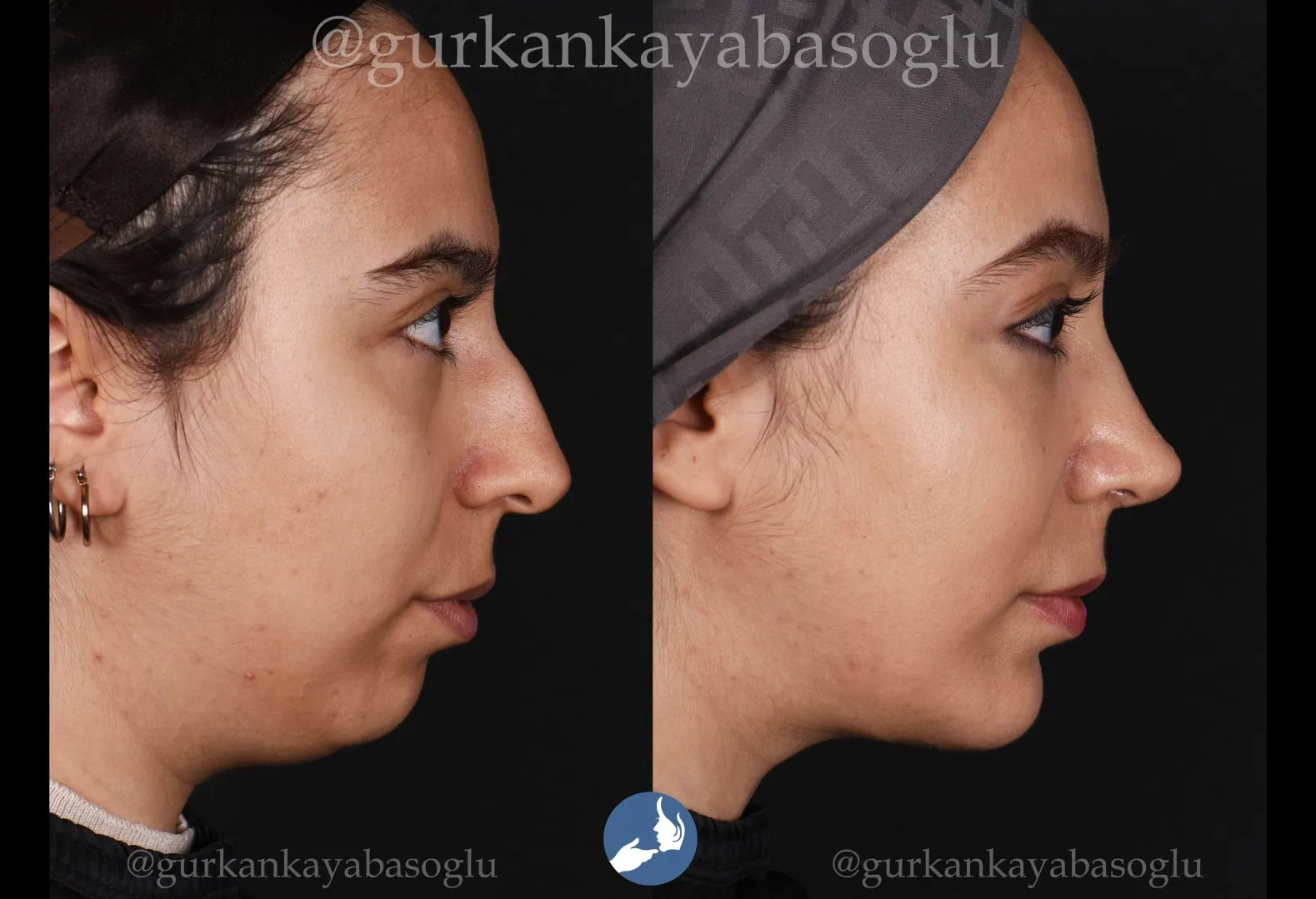 Chin implant (mentoplasty) — before and after, patient of Prof. Dr. Gürkan Kayabaşoğlu