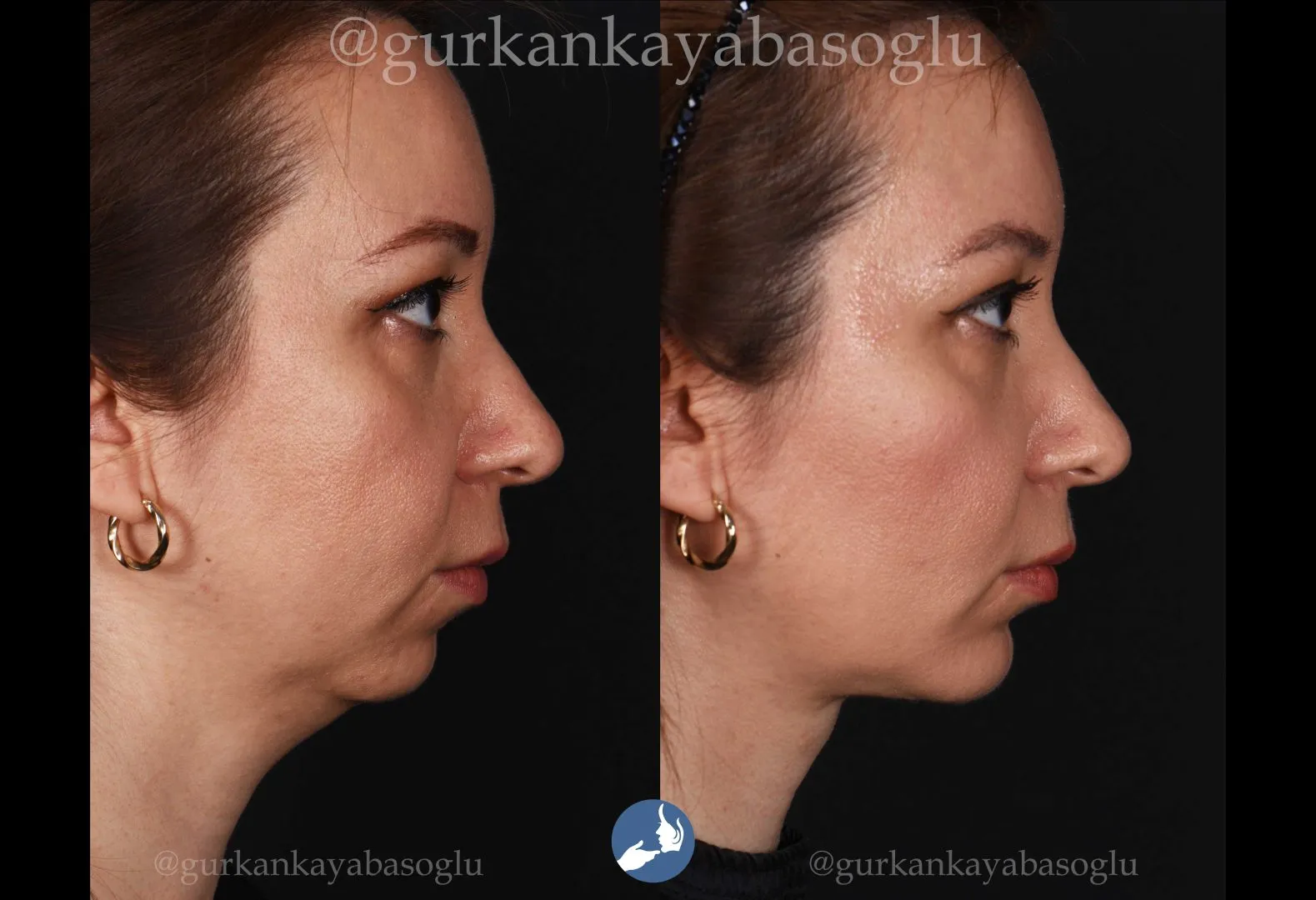 Chin implant (mentoplasty) — before and after, patient of Prof. Dr. Gürkan Kayabaşoğlu