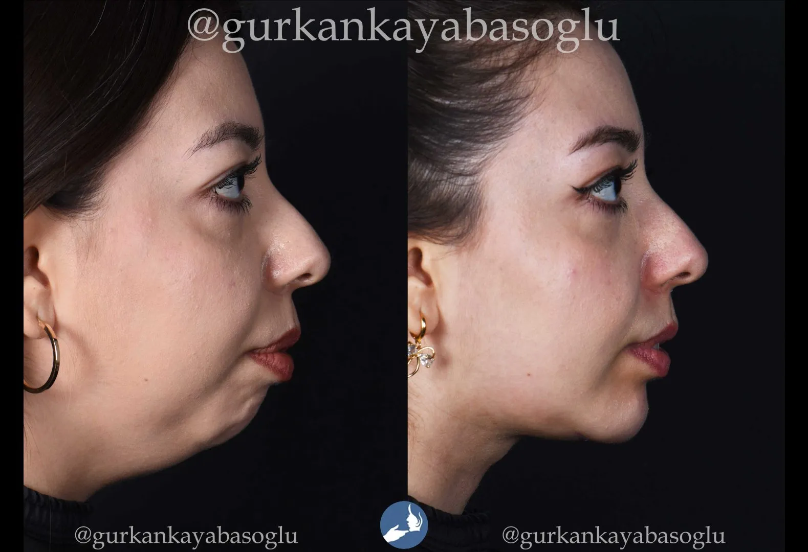 Chin implant (mentoplasty) — before and after, patient of Prof. Dr. Gürkan Kayabaşoğlu
