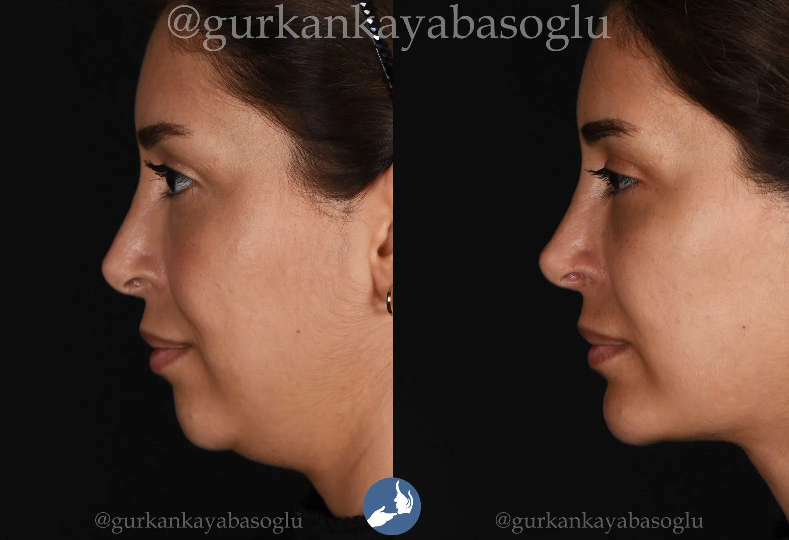 Chin implant (mentoplasty) — before and after, patient of Prof. Dr. Gürkan Kayabaşoğlu