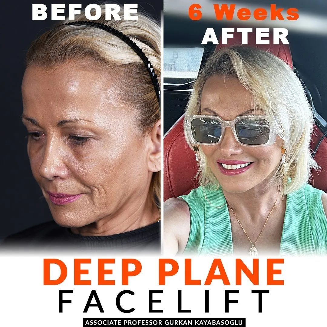 Deep plane facelift — before and after, patient of Prof. Dr. Gürkan Kayabaşoğlu