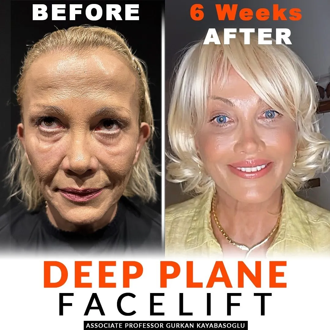 Deep plane facelift — before and after, patient of Prof. Dr. Gürkan Kayabaşoğlu