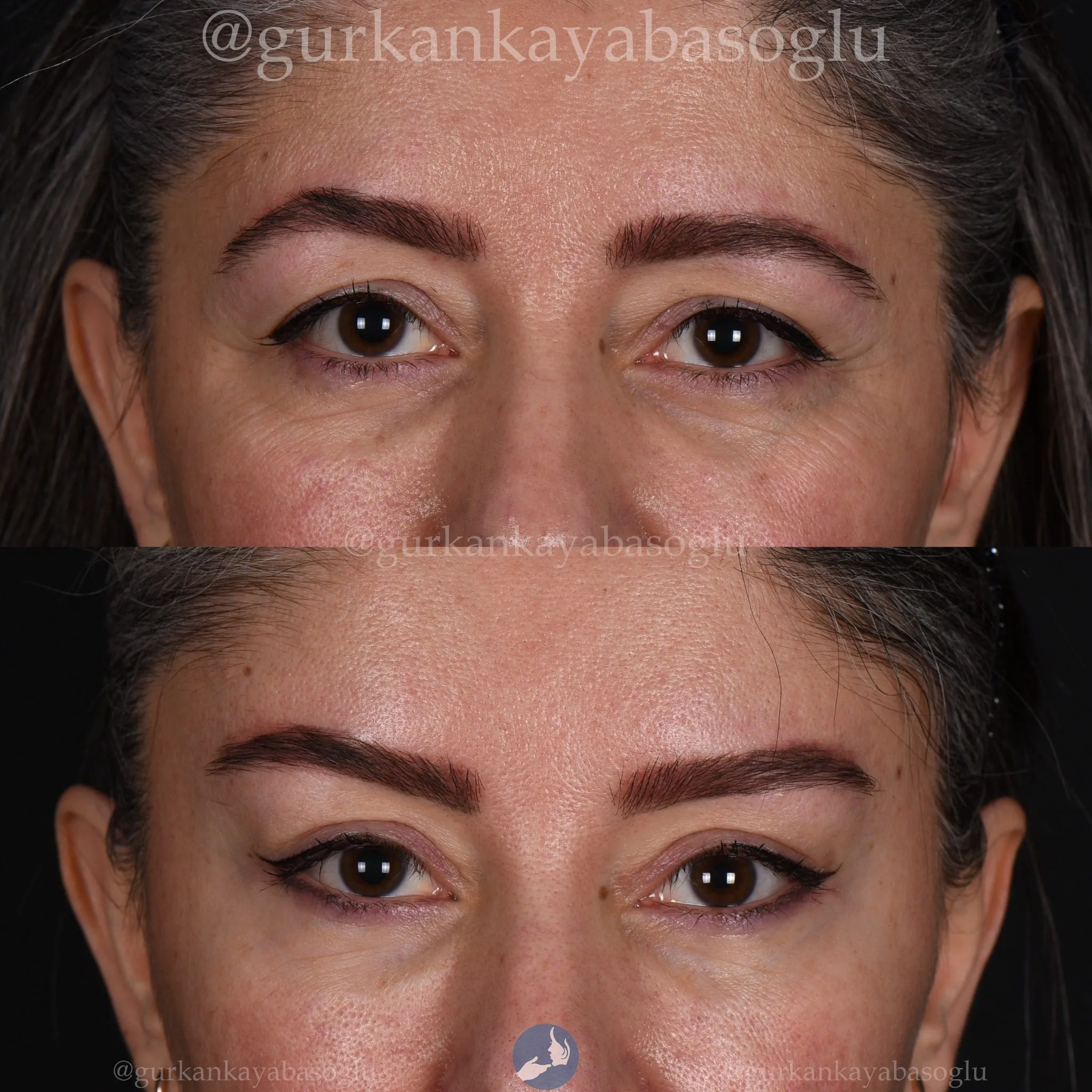Fox eye surgery — before and after, patient of Prof. Dr. Gürkan Kayabaşoğlu