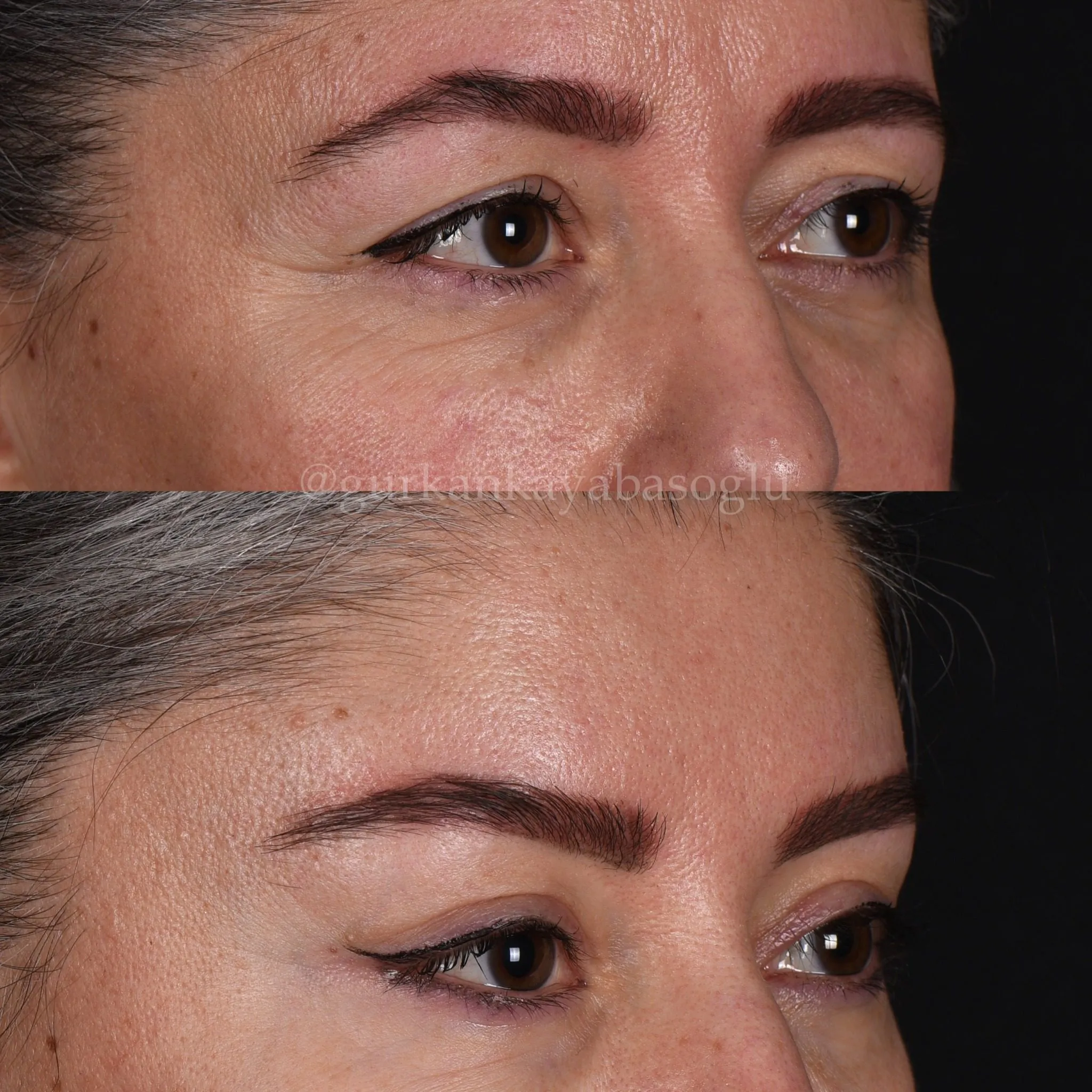 Fox eye surgery — before and after, patient of Prof. Dr. Gürkan Kayabaşoğlu