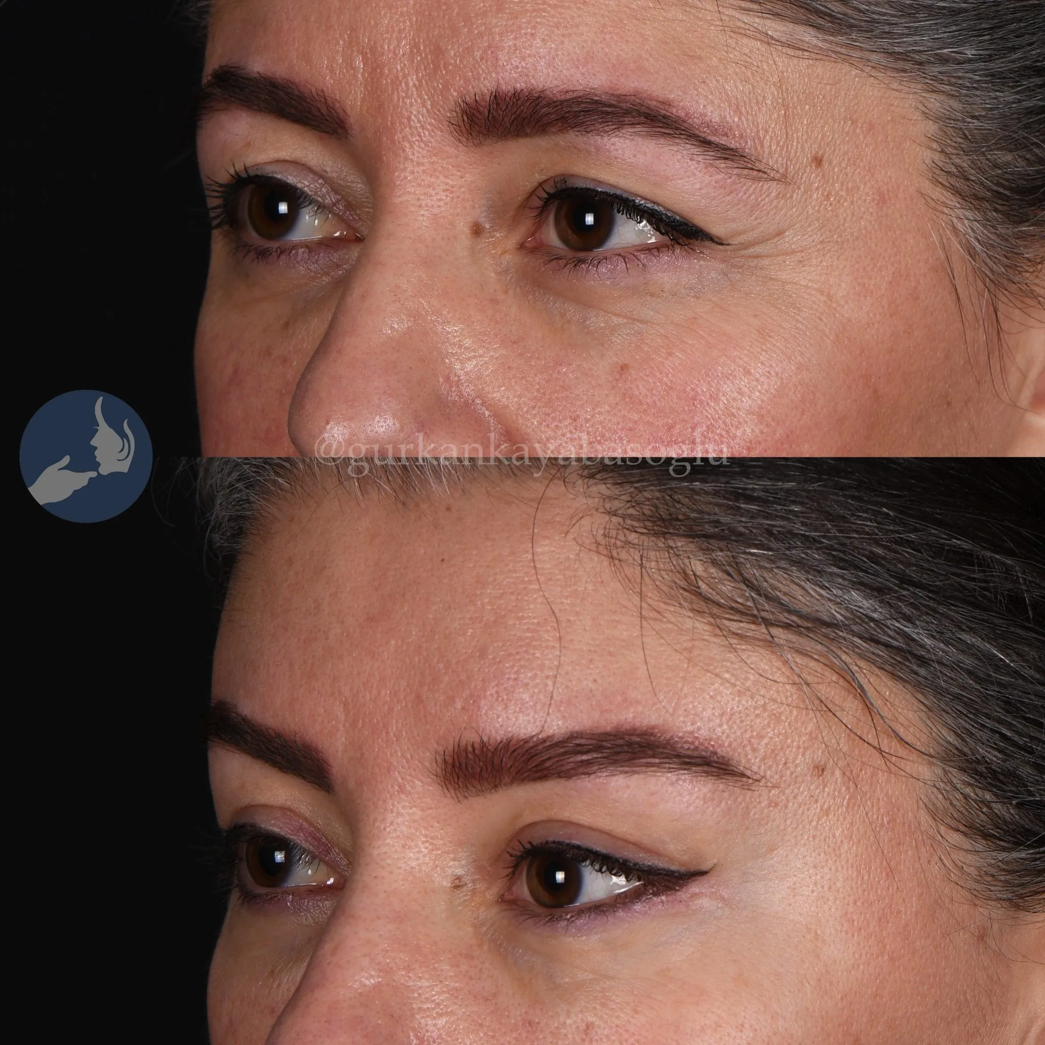 Fox eye surgery — before and after, patient of Prof. Dr. Gürkan Kayabaşoğlu