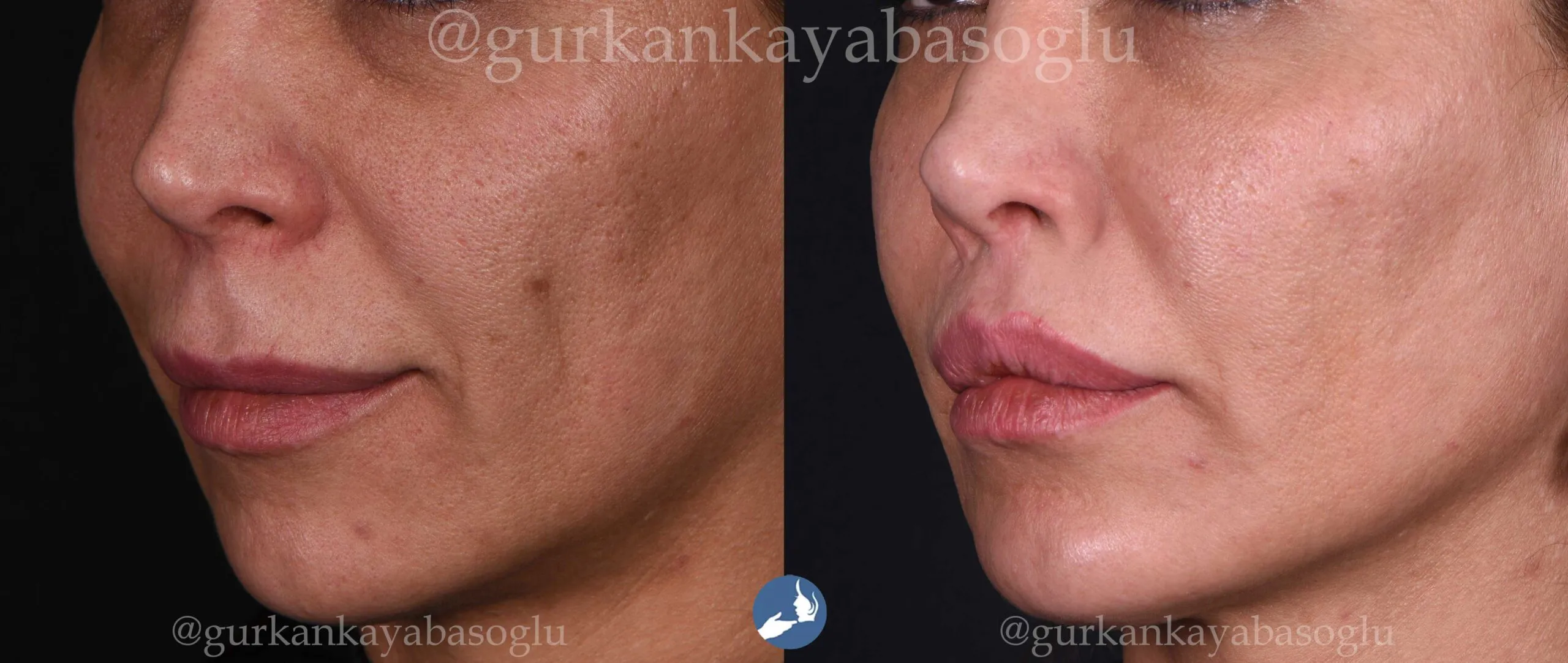 Lip lift — before and after, patient of Prof. Dr. Gürkan Kayabaşoğlu