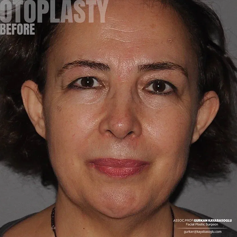 Otoplasty (ear reshaping) — before and after, patient of Prof. Dr. Gürkan Kayabaşoğlu